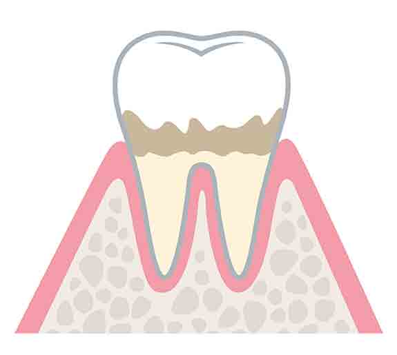 初期　歯肉炎
