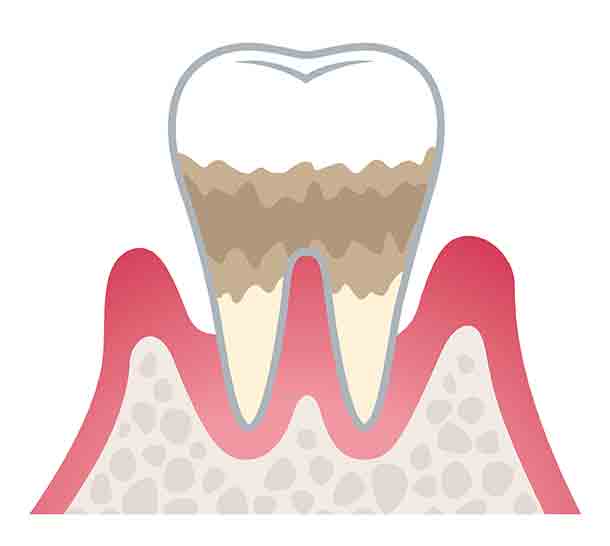 後期　中等度歯周炎