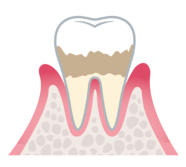 中期　軽度歯周炎