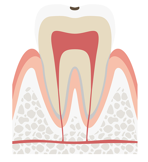 C1　エナメル質の虫歯