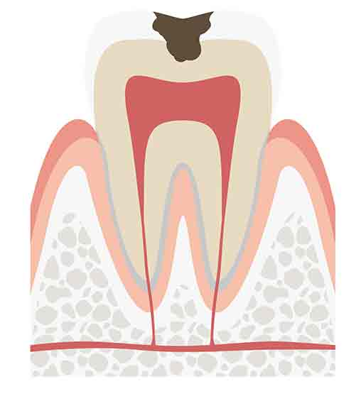 C2　象牙質の虫歯