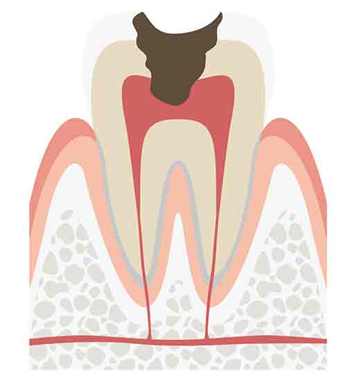 C3　神経に達した虫歯