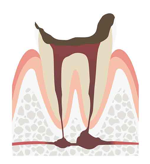 C4　末期の虫歯